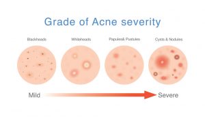 Is Laser Treatment Worth it for Acne and Scars? Beatitude Aesthetic Medicine, San Diego.