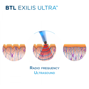 Cosmetic Treatments Spotlight: Exilis Ultra and Lutronic Genius