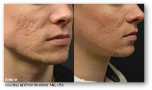 Improve acne scarring with Lutronic Genius - San Diego, CA - Beatitude Aesthetic Medicine (619) 280-1609.