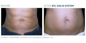 exilis system before and after