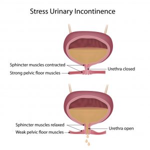 Stress urinary incontinence in women can be helped with BTL Emsella. Dr. Aeria Chang, San Diego.